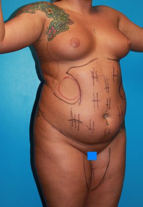 Liposuction Before & After Image