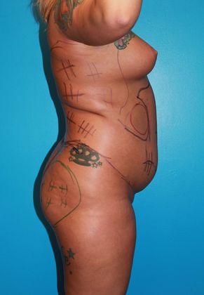 Liposuction Before & After Image