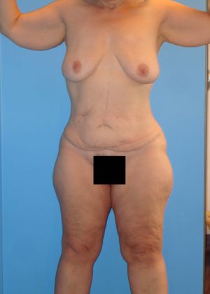 Thighplasty Before & After Image