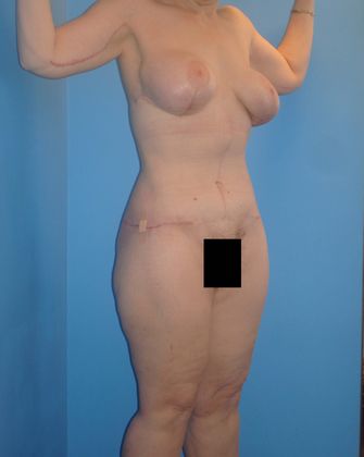 Thighplasty Before & After Image