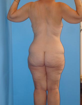 Thighplasty Before & After Image