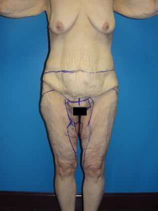 Thighplasty Before & After Image