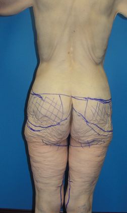 Thighplasty Before & After Image