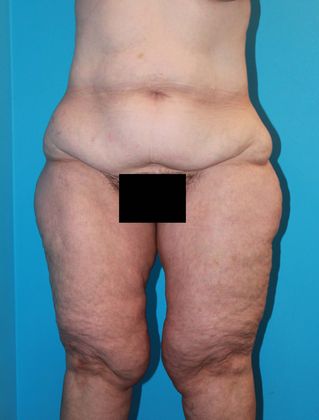 Thighplasty Before & After Image