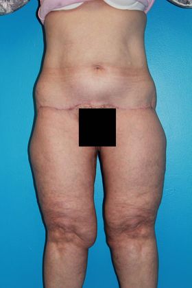 Thighplasty Before & After Image