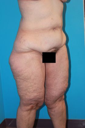 Thighplasty Before & After Image