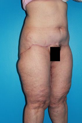 Thighplasty Before & After Image