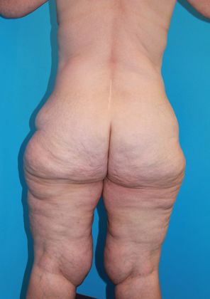 Thighplasty Before & After Image