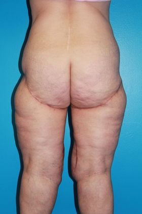 Thighplasty Before & After Image