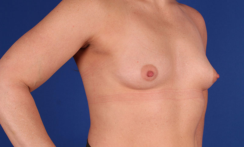 Breast Augmentation Before & After Image