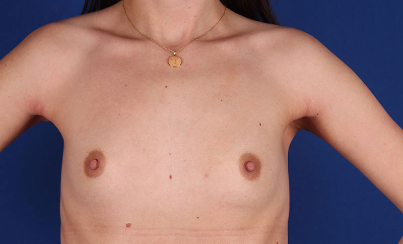 Breast Augmentation Before & After Image