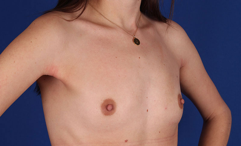 Breast Augmentation Before & After Image