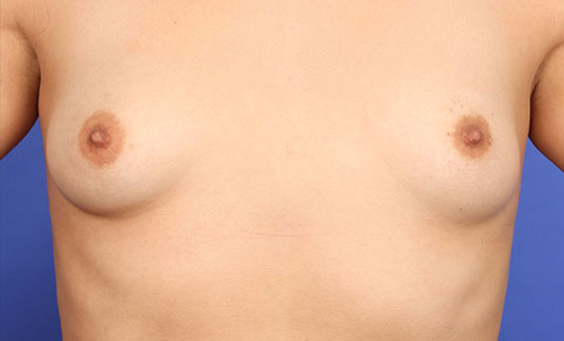 Breast Augmentation Before & After Image