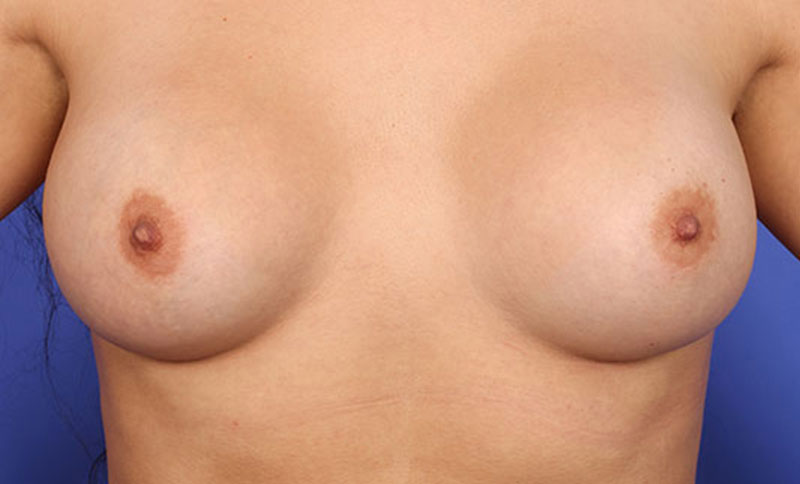 Breast Augmentation Before & After Image