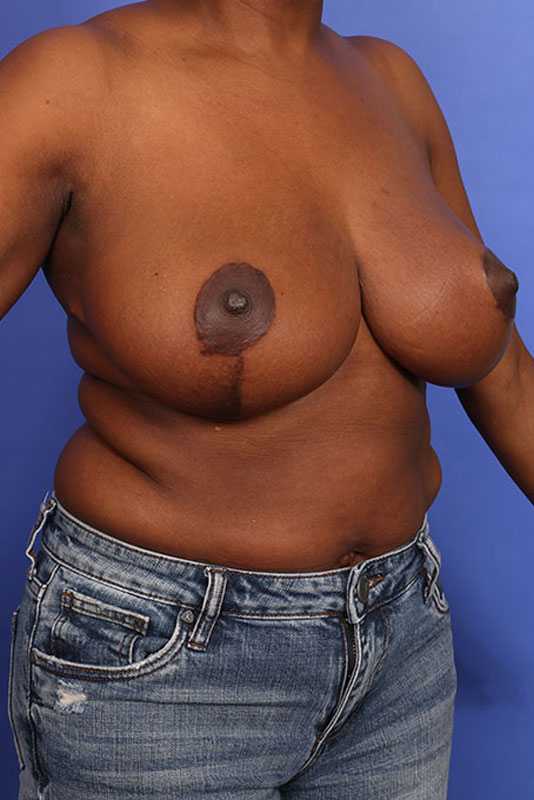 Breast Reduction Before & After Image