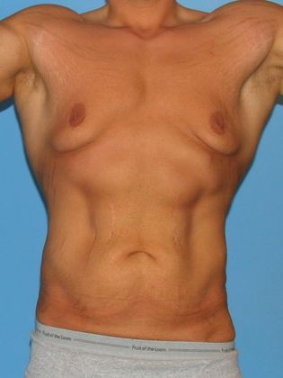 Gynecomastia Correction Before & After Image