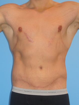 Gynecomastia Correction Before & After Image