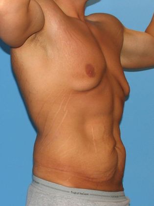 Gynecomastia Correction Before & After Image