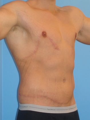 Gynecomastia Correction Before & After Image