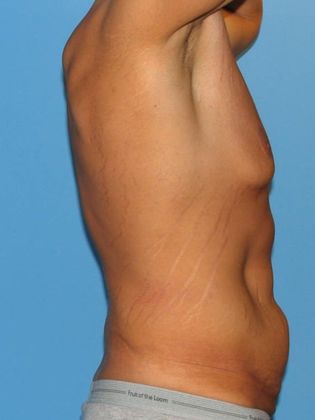 Gynecomastia Correction Before & After Image