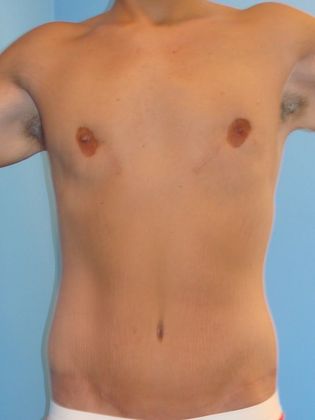 Gynecomastia Correction Before & After Image