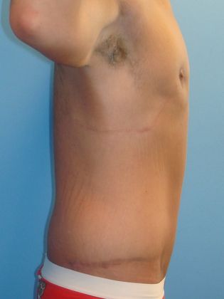 Gynecomastia Correction Before & After Image