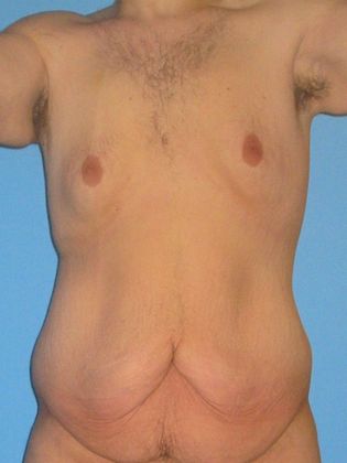 Gynecomastia Correction Before & After Image