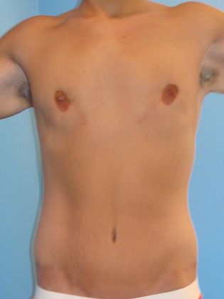 Gynecomastia Correction Before & After Image
