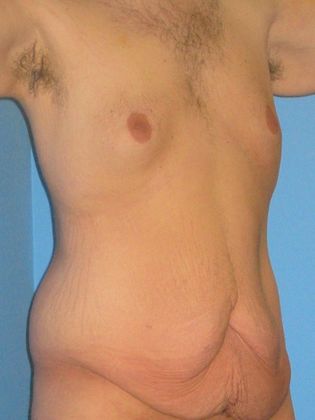 Gynecomastia Correction Before & After Image