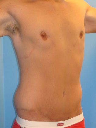 Gynecomastia Correction Before & After Image