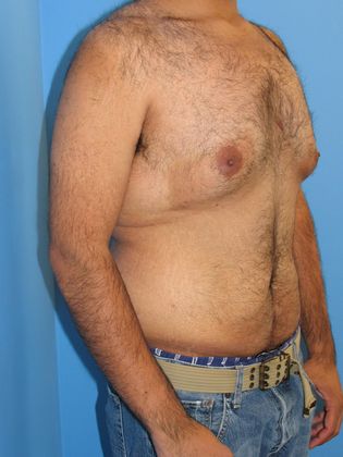 Gynecomastia Correction Before & After Image