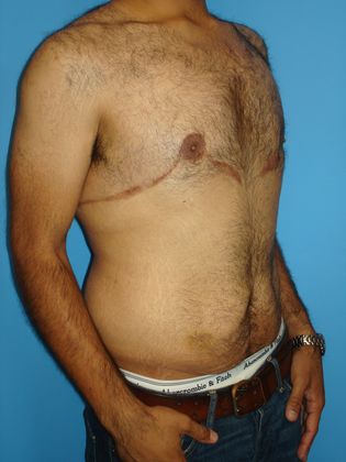 Gynecomastia Correction Before & After Image