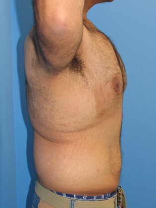 Gynecomastia Correction Before & After Image