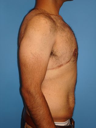 Gynecomastia Correction Before & After Image