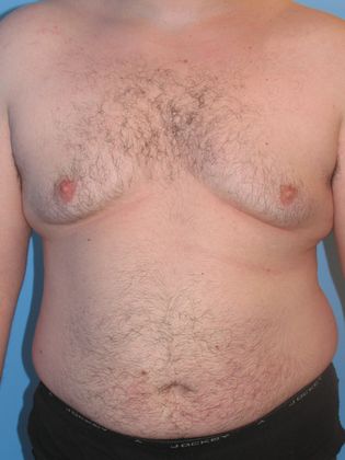 Gynecomastia Correction Before & After Image