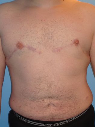 Gynecomastia Correction Before & After Image