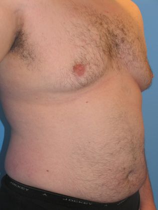 Gynecomastia Correction Before & After Image