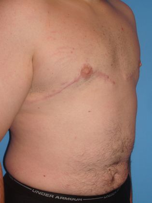 Gynecomastia Correction Before & After Image