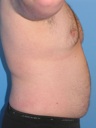 Gynecomastia Correction Before & After Image