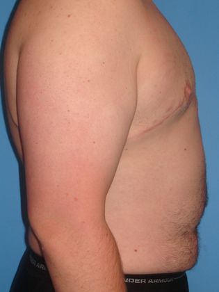 Gynecomastia Correction Before & After Image