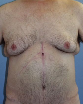 Gynecomastia Correction Before & After Image