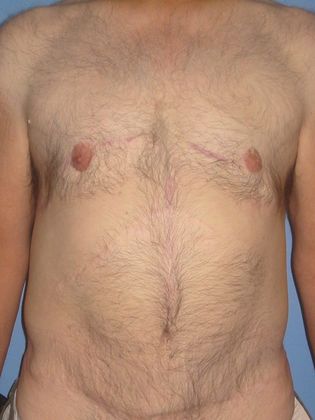 Gynecomastia Correction Before & After Image