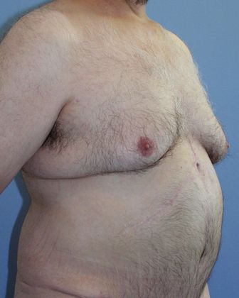 Gynecomastia Correction Before & After Image