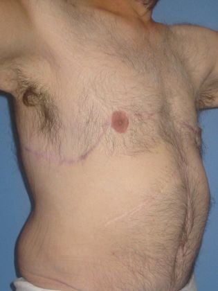 Gynecomastia Correction Before & After Image