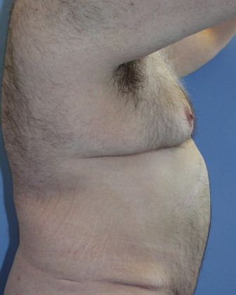 Gynecomastia Correction Before & After Image