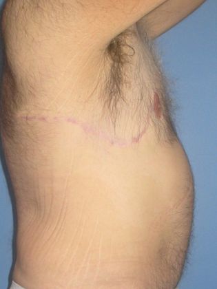 Gynecomastia Correction Before & After Image