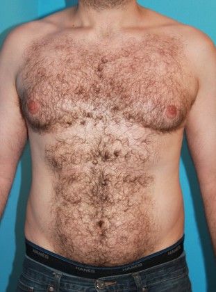 Gynecomastia Correction Before & After Image