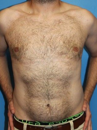 Gynecomastia Correction Before & After Image