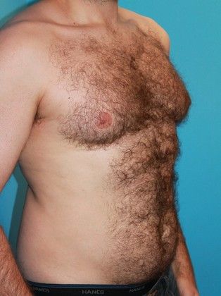 Gynecomastia Correction Before & After Image