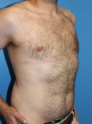 Gynecomastia Correction Before & After Image